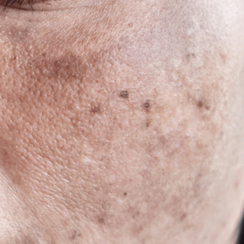 Flek _ Hiperpigmentasi (Spots _ Hyperpigmentation)