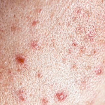 Jerawat _ Bekas Jerawat (Acne _ Acne Scars)